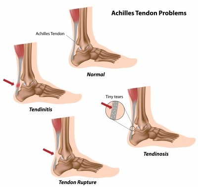 Do you have Achilles Tendonitis?
