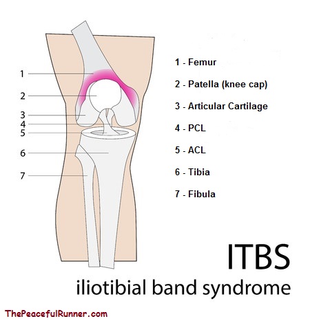 Understand & Prevent IT Band Syndrome